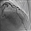 Takotsubo Cardiomyopathy in a Man With a Gunshot Wound