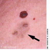 Macular Amyloidosis