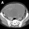 Mucinous Cystadenoma