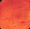 Diabetic Retinopathy