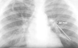 Spontaneous Fracture and Migration of a Catheter to the Pulmonary Artery