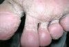 Tinea Pedis (Athlete’s Foot)