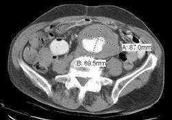 Abdominal Aortic Aneurysm With Impending Rupture