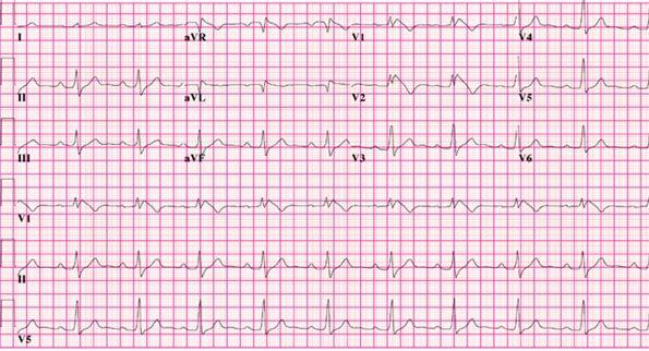 Syncopal Episode in an Otherwise Healthy 15-Year-Old Boy 