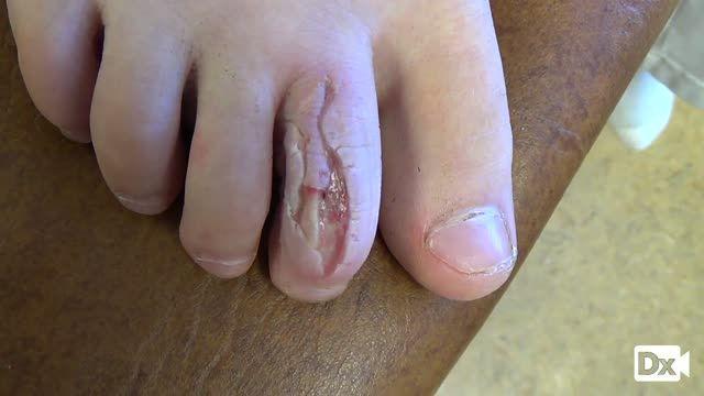 10-Year-Old With Infected Toe Laceration