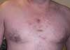 Hidradenitis Suppurativa