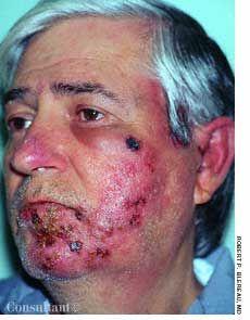 "Shingles" on a Man's Face