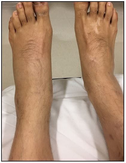 Unilateral leg edema, Baker's cyst 