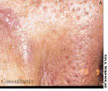 Desmoplastic Melanoma