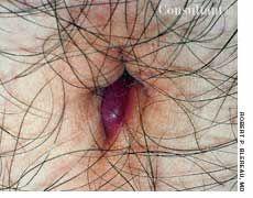 Pilonidal Cyst of the Umbilicus