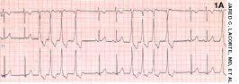 Nonsustained Ventricular Tachycardia