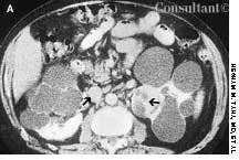 Acquired Cystic Kidney Disease and Renal Cell Carcinoma