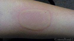 Idiopathic Cold Urticaria