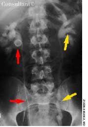 Brodifacoum Poisoning