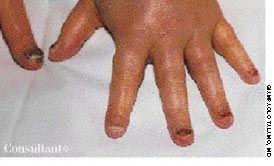 Docetaxel-Related Onycholysis