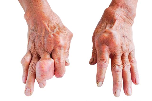 Excess Weight and Genetics May Put Women at Higher Risk of Gout