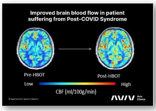 Long COVID: Hyperbaric Oxygen Therapy Offers Hope for Understanding and Treating Symptoms