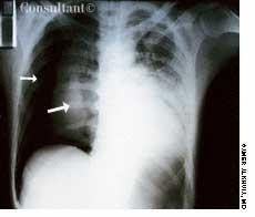 Tension Pneumothorax