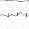 Apical Ballooning Syndrome