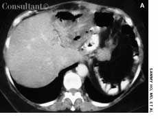 Liver Abscess