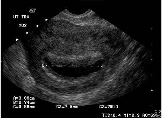 What Cause of Abdominal Pain, Vaginal Bleeding in a Young Woman? 