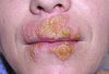 Orolabial Herpes