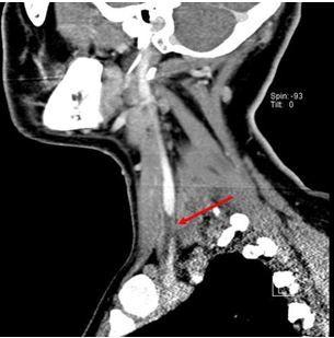 Lemierre syndrome 