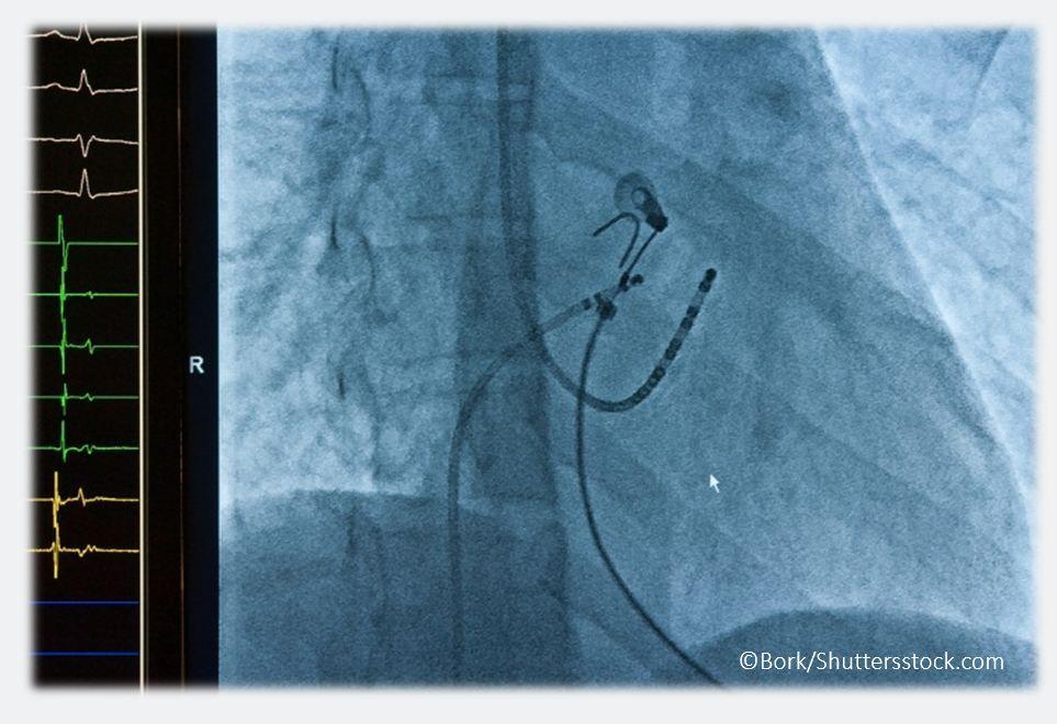 Should We Refer Symptomatic HF Patients for AF Ablation?