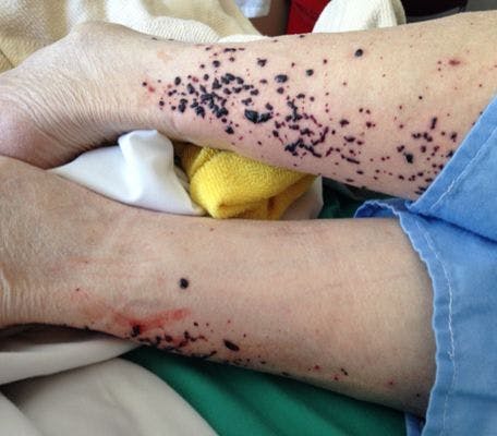 Enoxaparin dermatosis