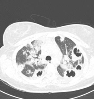 Lemierre syndrome 