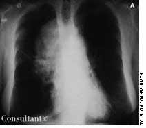 Superior Vena Cava Syndrome