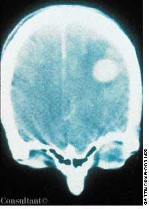 CNS Lymphoma