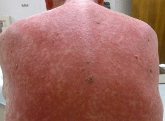 Rash in an Immunocompromised Man: Your Dx?