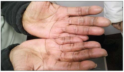 raynaud phenomenon