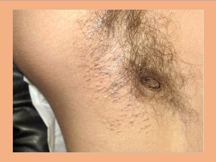 Underarm Eruption in a Teenaged Boy