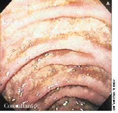 AIDS Patient With Persistent Diarrhea