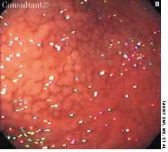 Diffuse Gastric Polyposis