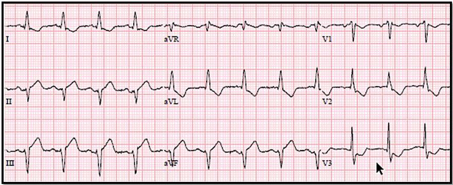 Older Man with Cough and Shortness of Breath: A Surprising Diagnosis