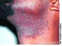 Pseudofolliculitis Barbae