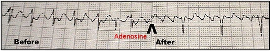 Atrial flutter