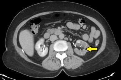 Renal Infarction in the Setting of Undiagnosed Paroxysmal Atrial Fibrillation