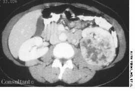 Renal Cell Carcinoma