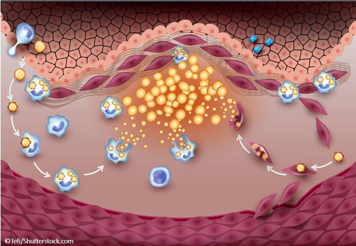 Bempedoic Acid Meets Primary Endpoint in Key Cardiovascular Outcomes Trial: CLEAR