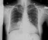 Heparin-Induced Thrombocytopenia