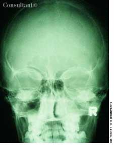 Maxillary Sinusitis