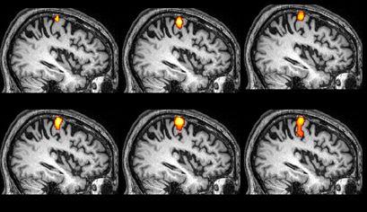 Cryptogenic Stroke: Is Occult Arrhythmia a Factor? 