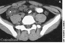 Acute Appendicitis