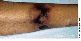 Calciphylaxis