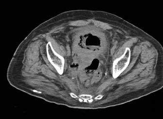 A Rare Reversal of Clostridium perfringens Necrotizing Fasciitis