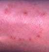 Negative-Culture Tinea Corporis